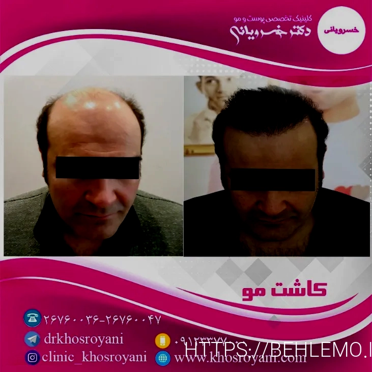 کاشت مو تهران